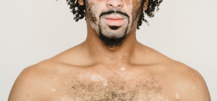 Vitiligo führt zu weißen Flecken auf der Haut